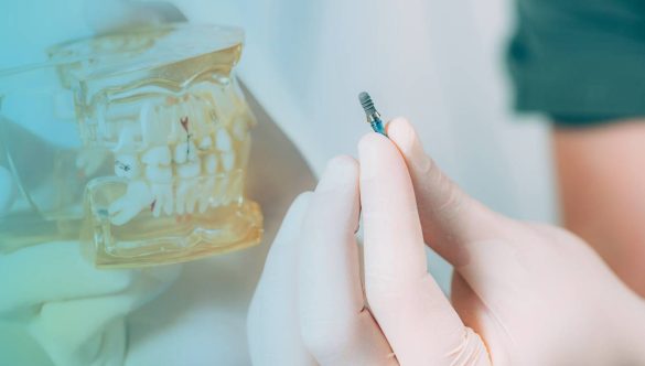 Preguntas Frecuentes sobre Implantes Dentales