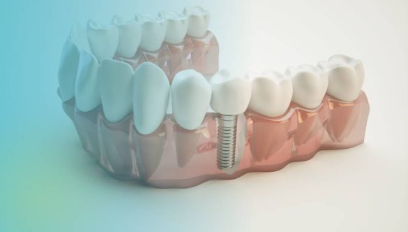 ¿Qué son los Implantes Dentales?