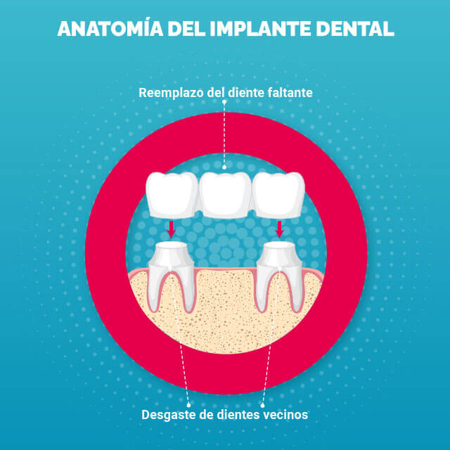 anotomia_del_implante