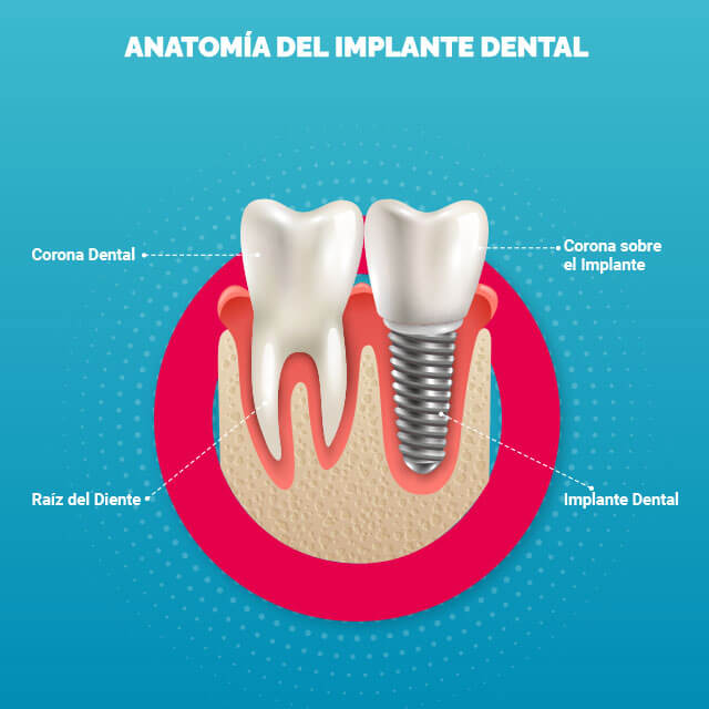 anotomia_del_implante_1