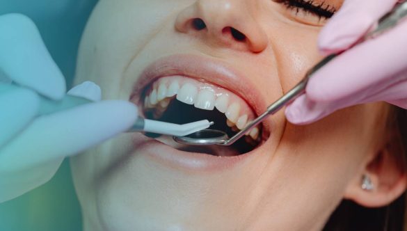 Difference between Gingivitis and Periodontitis