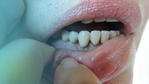 What is a Periodontal Disease?