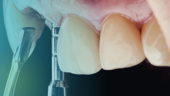 Maxillary Sinus Lift