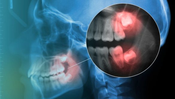 Why do we have to extract our Wisdom Teeth?