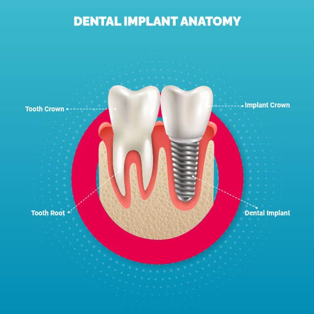 dental_implant