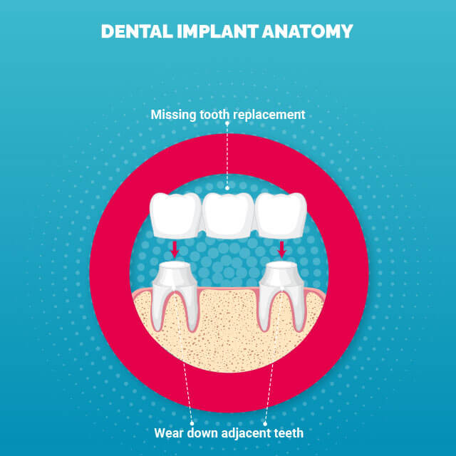 dental_implant_anatomy