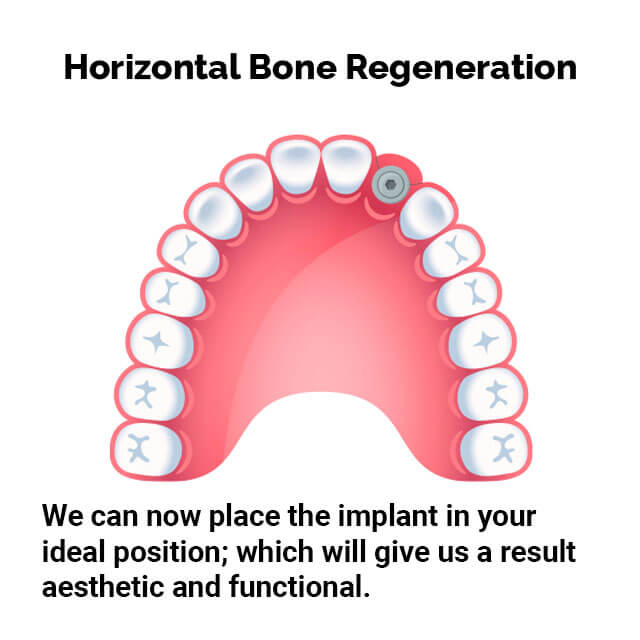 horinzontal_bone_reg