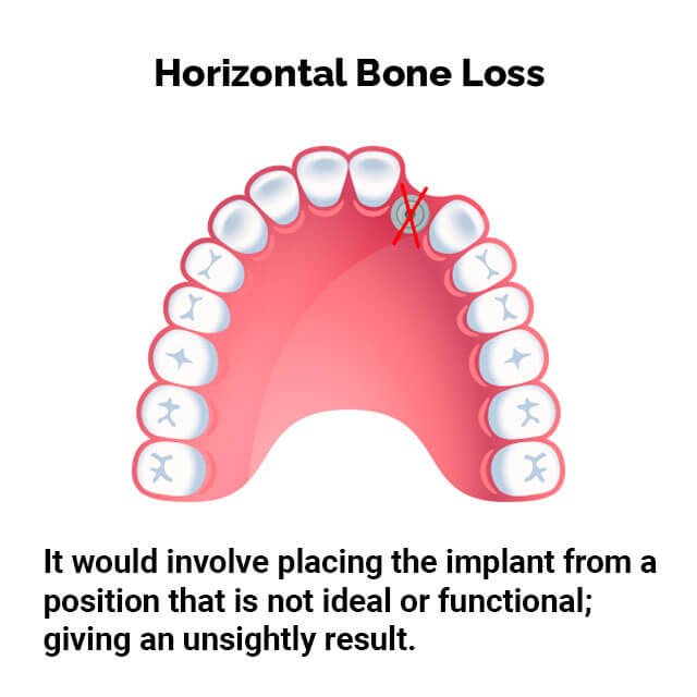 horizontal_bone_loss