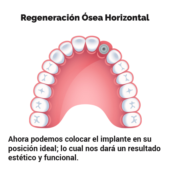 regeneracion_osea_horizontal