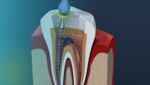 Endodoncia